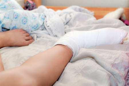 The girl is resting on the bed after a broken leg. Bandaged human leg.の写真素材