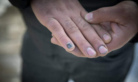 Human showing broken nail in hand.