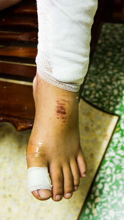 lesion の写真素材