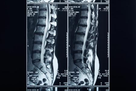 X-ray spineの写真素材