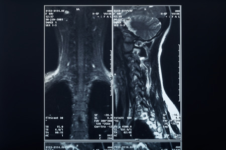 X-ray spine and neck radiographyの写真素材
