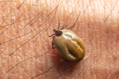 A tick drunk on blood crawls on human skin.の写真素材