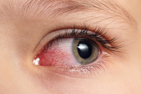 Closeup irritated infected red bloodshot eyes, conjunctivitis.の写真素材