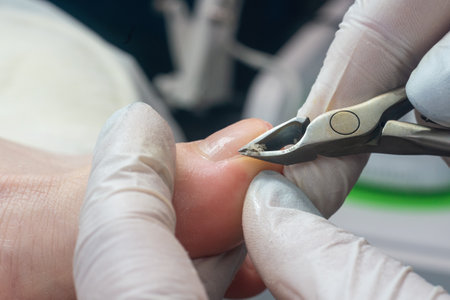 Podiatrist using pedicure clippers trims dry skin around a toenail.の写真素材