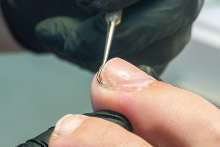 Medical pedicure, podiatrist doing tamponade to a deformed toenail.