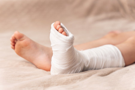 Little girl with broken leg in plaster lies on bed.の写真素材