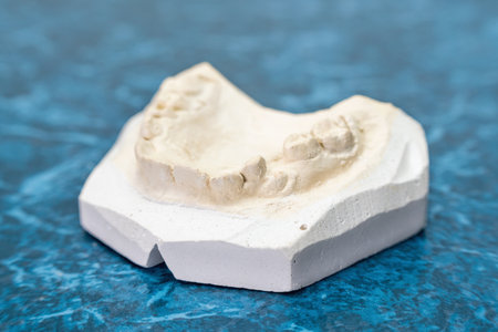 Dental plaster cast on a blue background in a dental laboratory.の写真素材