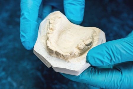 The dentist's hands hold a plaster cast of the upper jaw teeth.