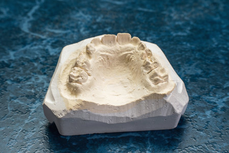 Dental plaster cast on a blue background in a dental laboratory.