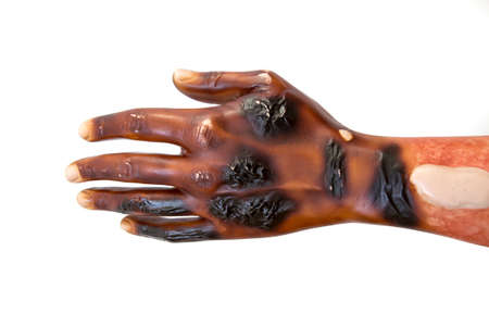 Third degree burn injury on a dummy hand. Front face of palm.の写真素材