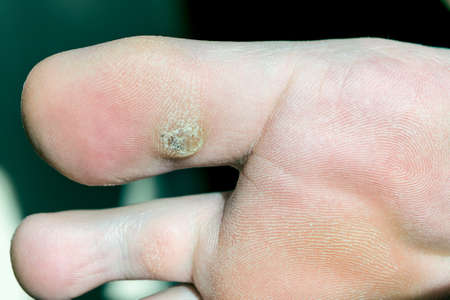 Plantar wart on big toe. Visible black dots warts. Shown the sole of the foot and toes.の写真素材