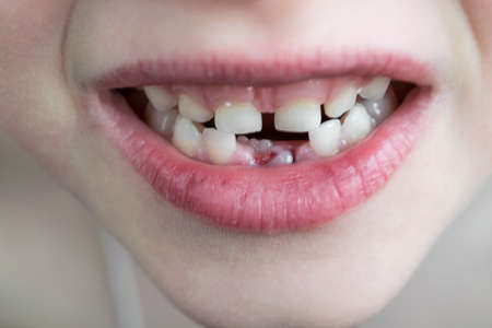 The open mouth of the child. Two rows of teeth. In the bottom row fell out two milk teeth. Growing an adult tooth. Visible crack and the wound on the lower gum after the removal of the lower teeth.の写真素材