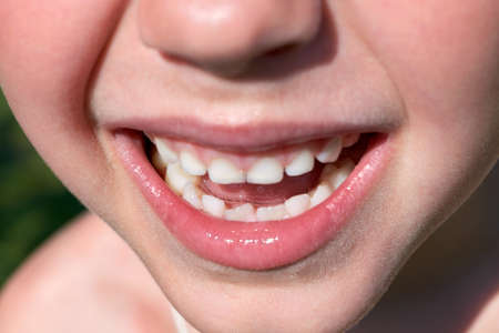 The smile of a small child. Mouth open, showing baby teeth. The two lower front teeth are adults....