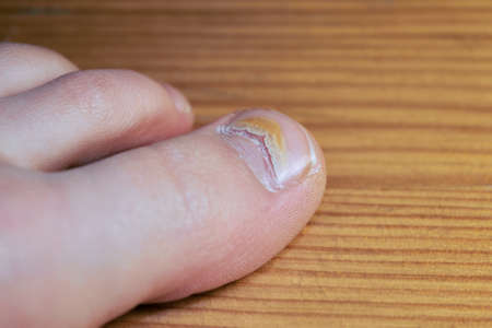 A damaged toenail on the big toe from a virus or enterovirus. There is a large crack on the nail and...