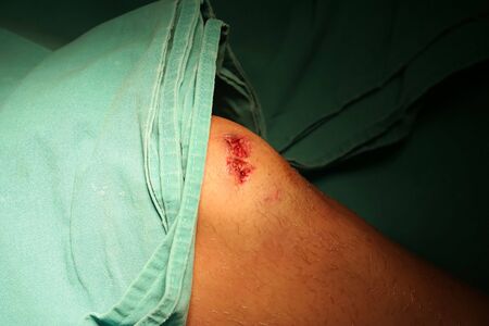 Get the knee stitched up after fall with mountain bike