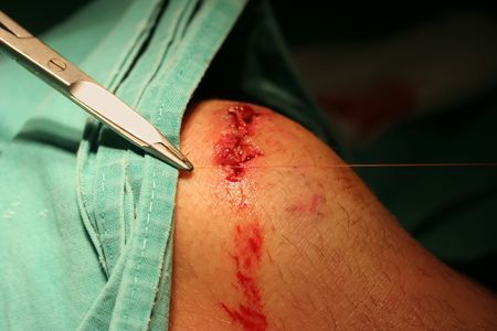 Get the knee stitched up after fall with mountain bikeの写真素材
