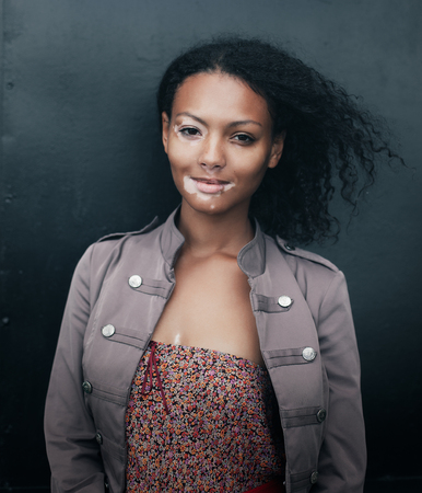 beautiful young brunette woman with vitiligo disease on the black backgroundの写真素材