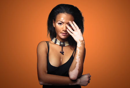 Beautiful African girl in studio with skin problems Vitiligo. studio shooting. On the terracotta color background with free space for your textの写真素材