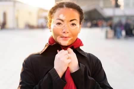 A beautiful young girl of African ethnicity with vitiligo standing on the warm spring city street dressed black coat close up portrait of woman with skin problems.の写真素材