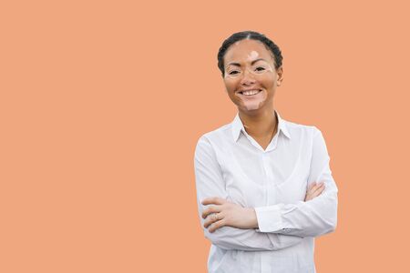 A beautiful young girl of African ethnicity with vitiligo isolated on the color background.の写真素材