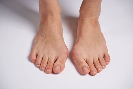 Hllux Valgus on female legs close up isolated on white background. Foot joint deformity. Health care...