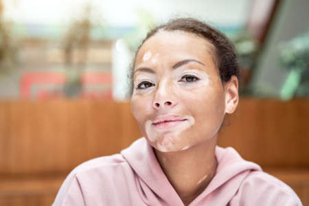 Black african american woman with vitiligo pigmentation skin problem indoor dressed pink hoodie close up portrait pensive black female thinking aboutの写真素材