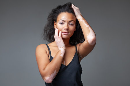Confident sensuous female fashion model with vitiligo skin disease against gray background. Portrait of glamorous young lady in black tank top at studio.の写真素材