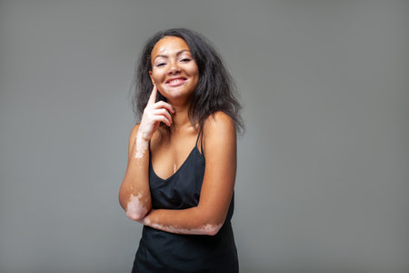 Happy glamorous female fashion model with vitiligo skin disease posing against gray background. Portrait of smiling sensuous lady in black tank top standing with finger on cheek in studioの写真素材