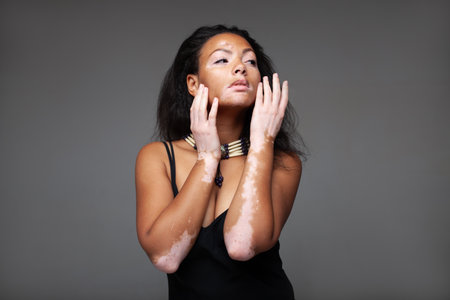 Confident sensuous female fashion model with vitiligo skin disease against gray background. Glamorous young lady in black tank top is looking away in studioの写真素材