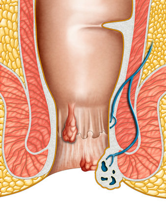 Anatomical drawing showing internal and external hemorrhoids. Digital illustration.の写真素材