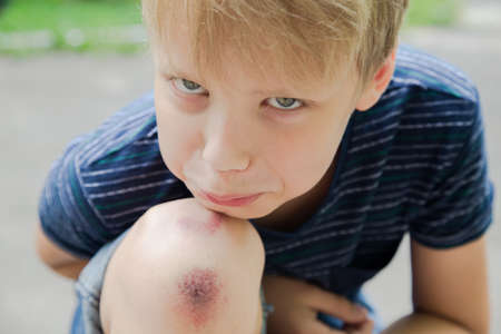 Closeup of injured young kid's knee after he fell down on pavement. Boy's face and wounded scraped leg on summer day outdoors. Horizontal color photo.の写真素材