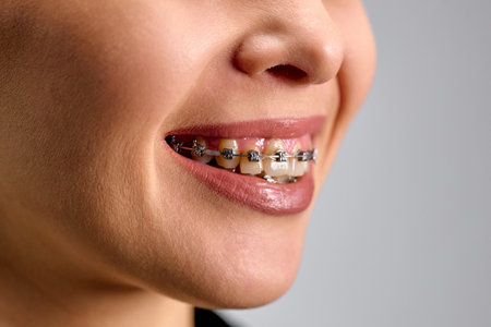 Close-up of a jaw corrected for crookedness using braces.