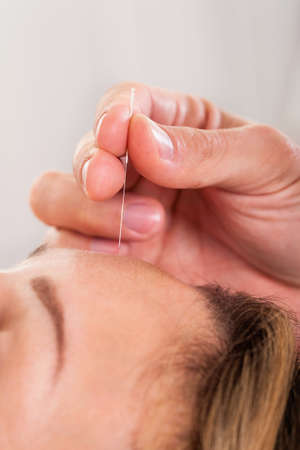 Woman undergoing acupuncture treatment with a line of fine needles inserted into the skin of her foreheadの写真素材