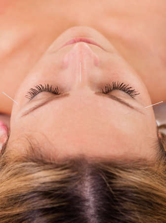 Woman undergoing acupuncture treatment with a line of fine needles inserted into the skin of her foreheadの写真素材