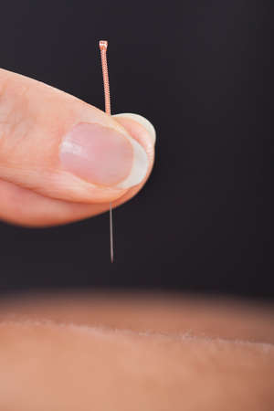Close-up Of A Person Getting An Acupuncture Treatment At Spa