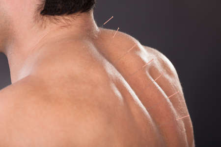 Close-up Of A Shirtless Man With Acupuncture Needles On Backの写真素材