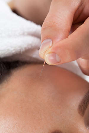 Closeup of woman receiving acupuncture treatment at beauty spaの写真素材