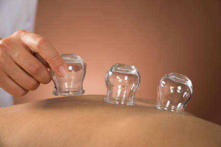Close-up Of Person Hand Giving Cupping Treatment To Woman