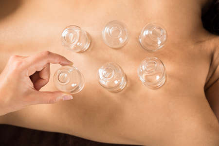 Close-up Of Therapist's Hand Placing Cups On Woman's Backの写真素材