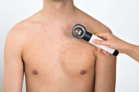 Close-up Of Person Hands Examining Acne Skin Of Man With Dermatoscope