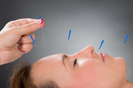 Close-up Person Hands Putting Acupuncture Needle On Face Of Young Womanの写真素材