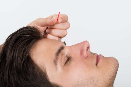 Close-up Of Young Man Receiving Acupuncture Treatmentの写真素材