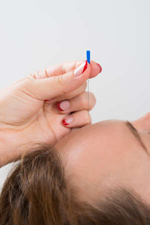 Close-up Of Young Beautiful Woman Receiving Acupuncture Treatmentの写真素材