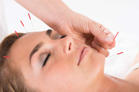 Closeup of hand performing acupuncture therapy on head and chin at salonの写真素材
