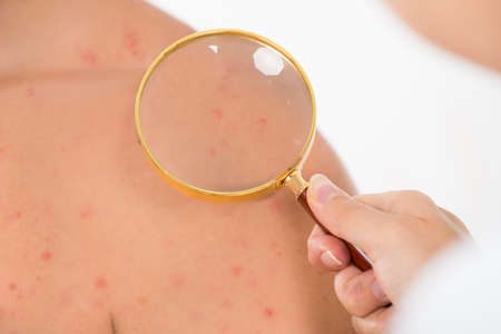 Close-up Of Doctor Examining Skin Acne Of Male Patient With Magnifying Glass