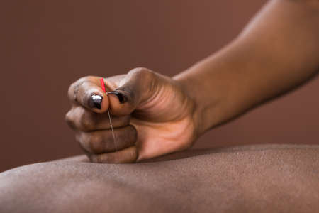 Young African Man Getting Acupuncture Treatment In Spaの写真素材