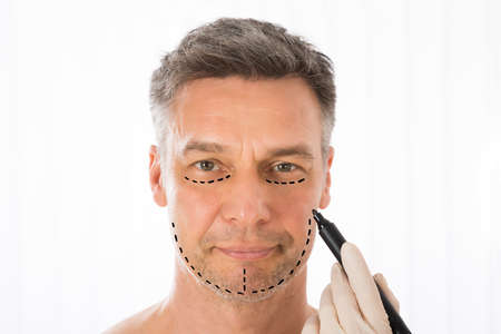Close-up Of Surgeon Hands Drawing Correction Lines On Man Face With Markerの写真素材