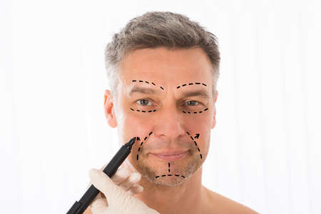 Close-up Of Surgeon Hands Drawing Correction Lines On Man Face With Markerの写真素材
