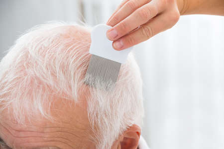 Close-up Of Doctor Doing Treatment On Senior Patient's Hair With Combの写真素材