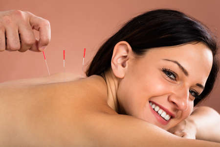 Close-up Of A Smiling Young Woman Receiving Acupuncture Treatment In Spaの写真素材